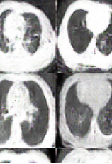 COVID-19 胸部CT图像增强GAN数据集