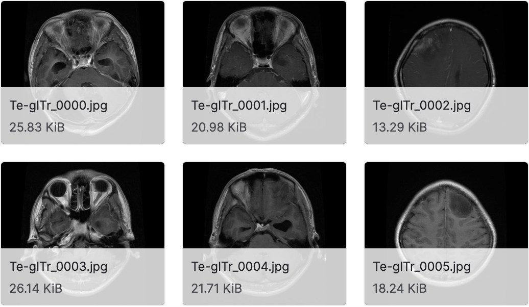脑肿瘤 MRI 数据集