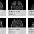 脑肿瘤 MRI 数据集